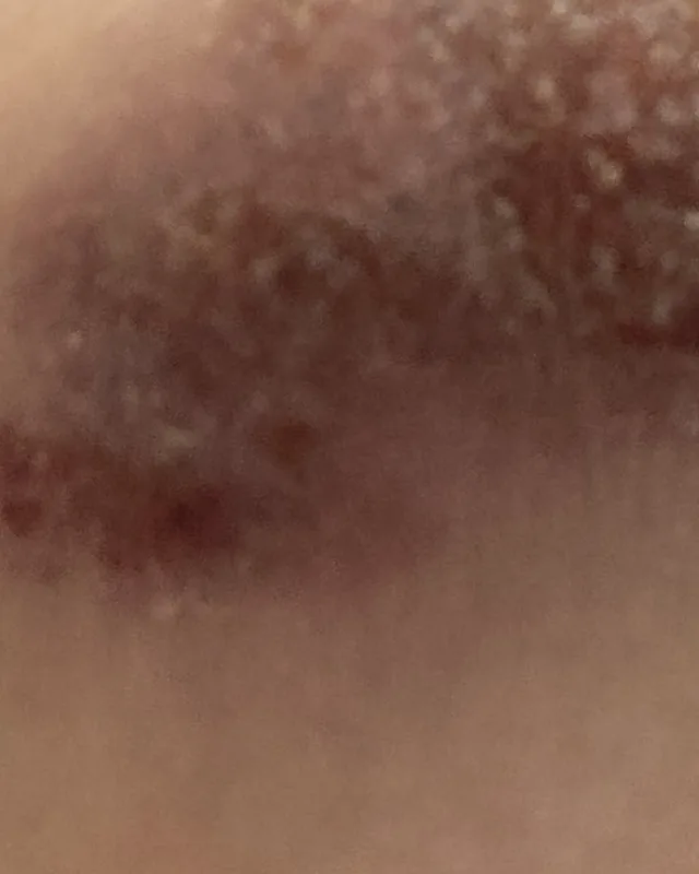 標示為 8 月 1 日的下巴皮膚特寫
