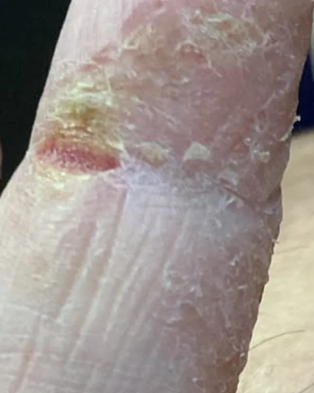 標示為 8 月 6 日的手指皮膚特寫