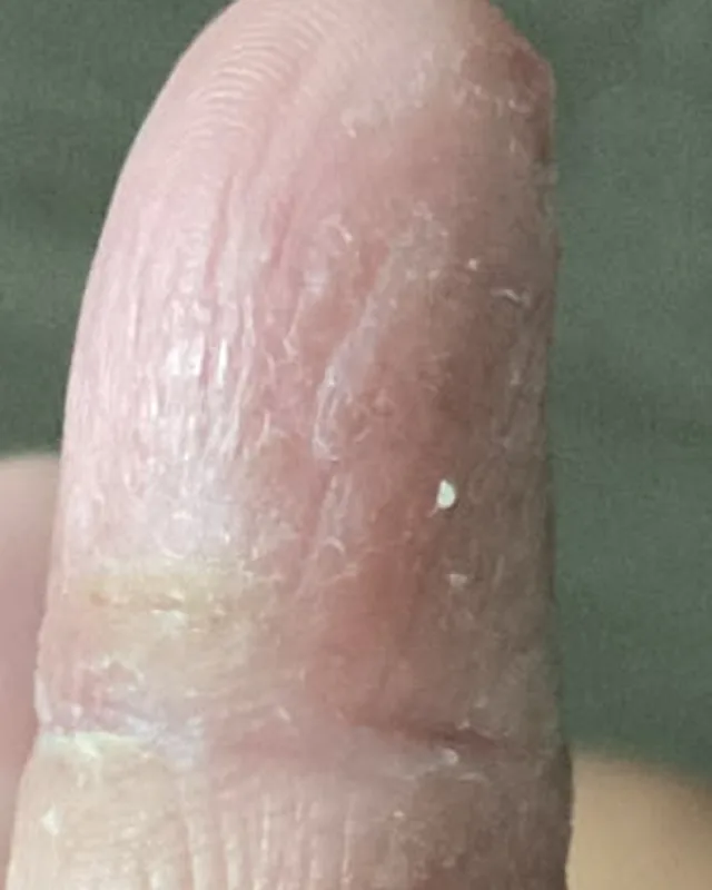 標示為 8 月 18 日的同一手指皮膚特寫