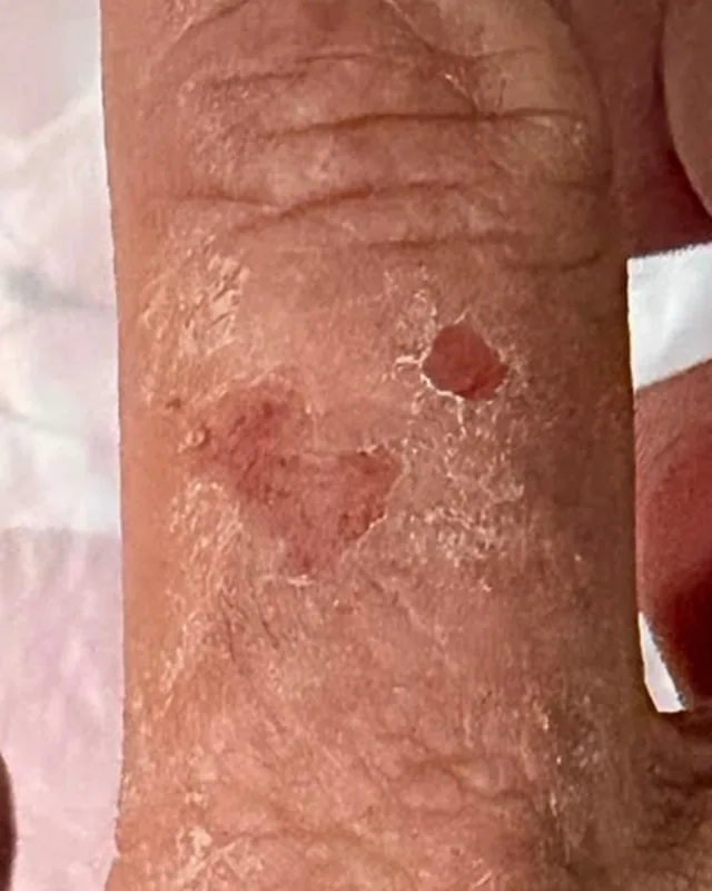第 0 日手指皮膚的局部相片
