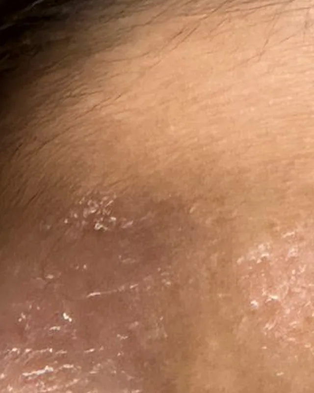 第 0 日額頭皮膚的局部相片