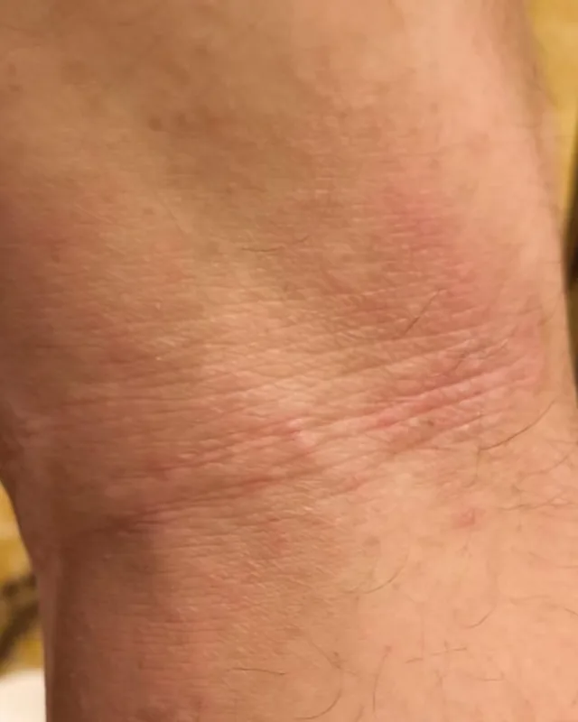 第 28 日膝後皮膚的局部相片
