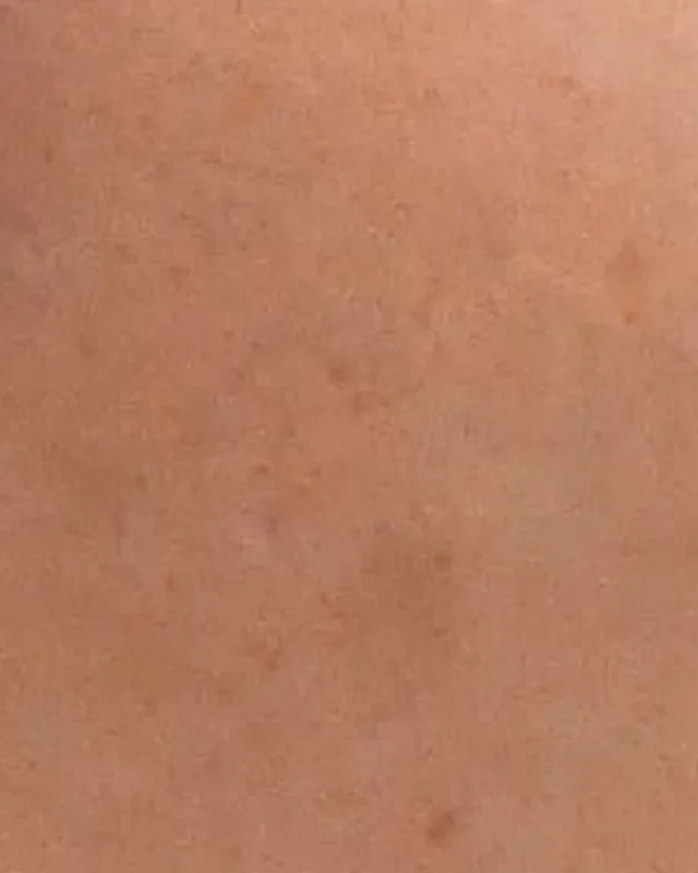 較後拍攝的右面頰皮膚特寫
